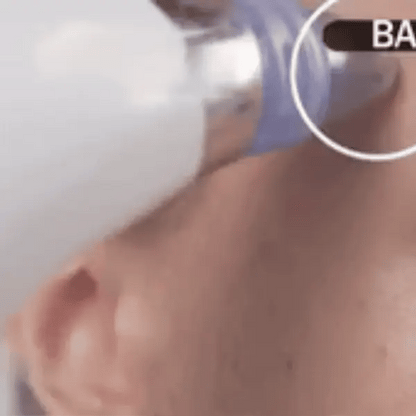 DermaGlow Suction Pro
