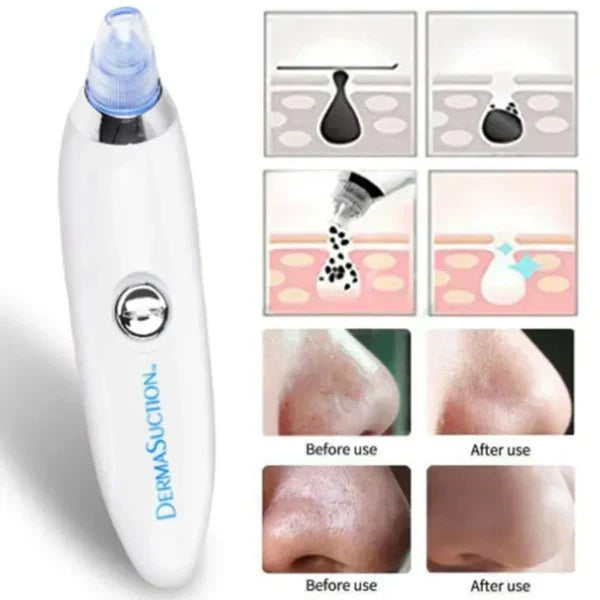 DermaGlow Suction Pro